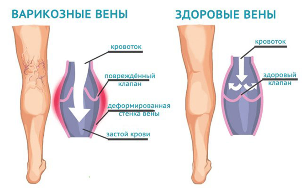 Какого характера патологические процессы в организме при варикозном расширении вен?