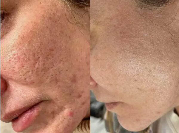 Лазерная шлифовка лица